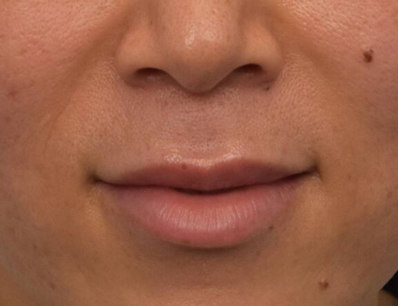 Lip Lift Before & After Image