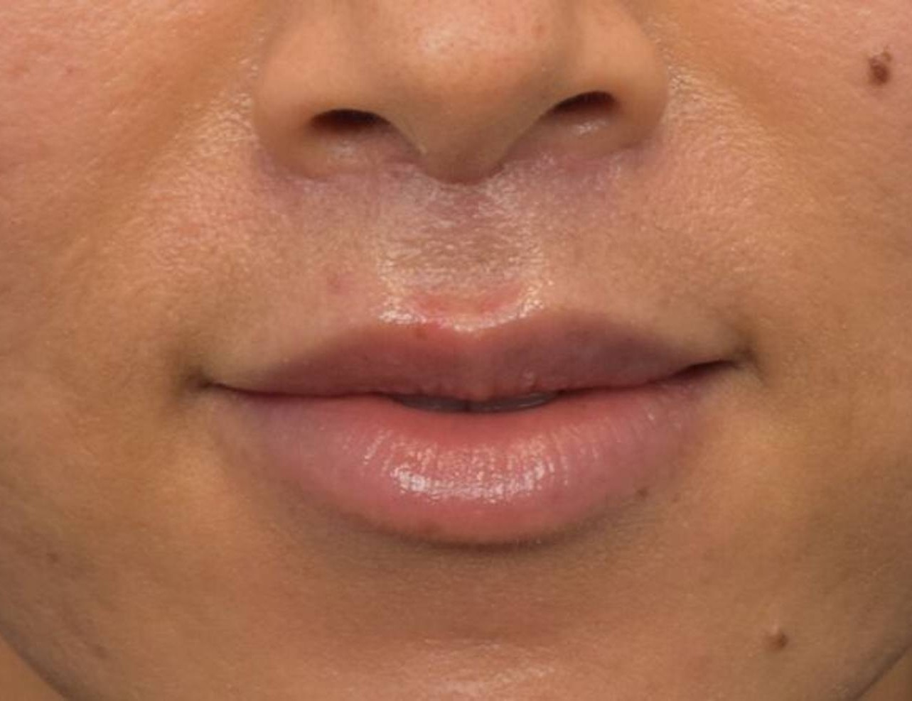 Lip Lift Before & After Image