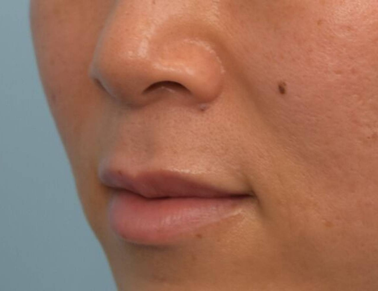 Lip Lift Before & After Image