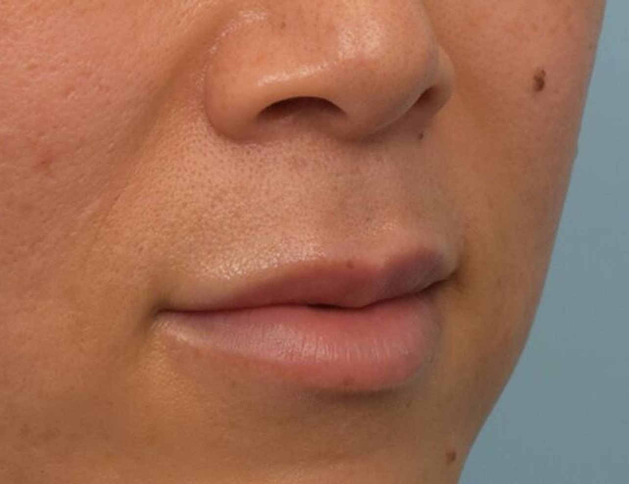 Lip Lift Before & After Image