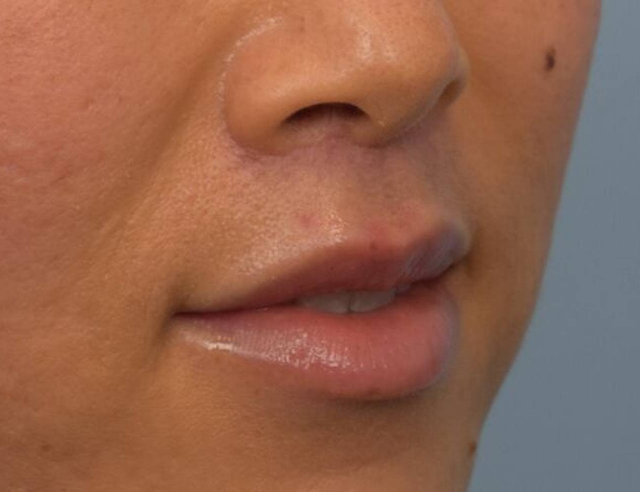 Lip Lift Before & After Image