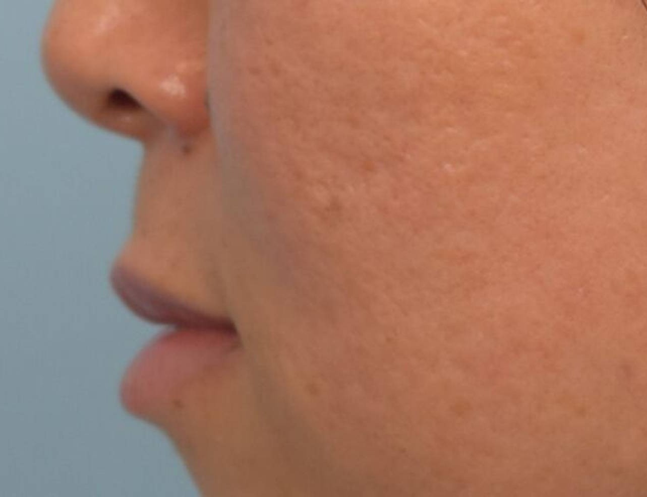 Lip Lift Before & After Image