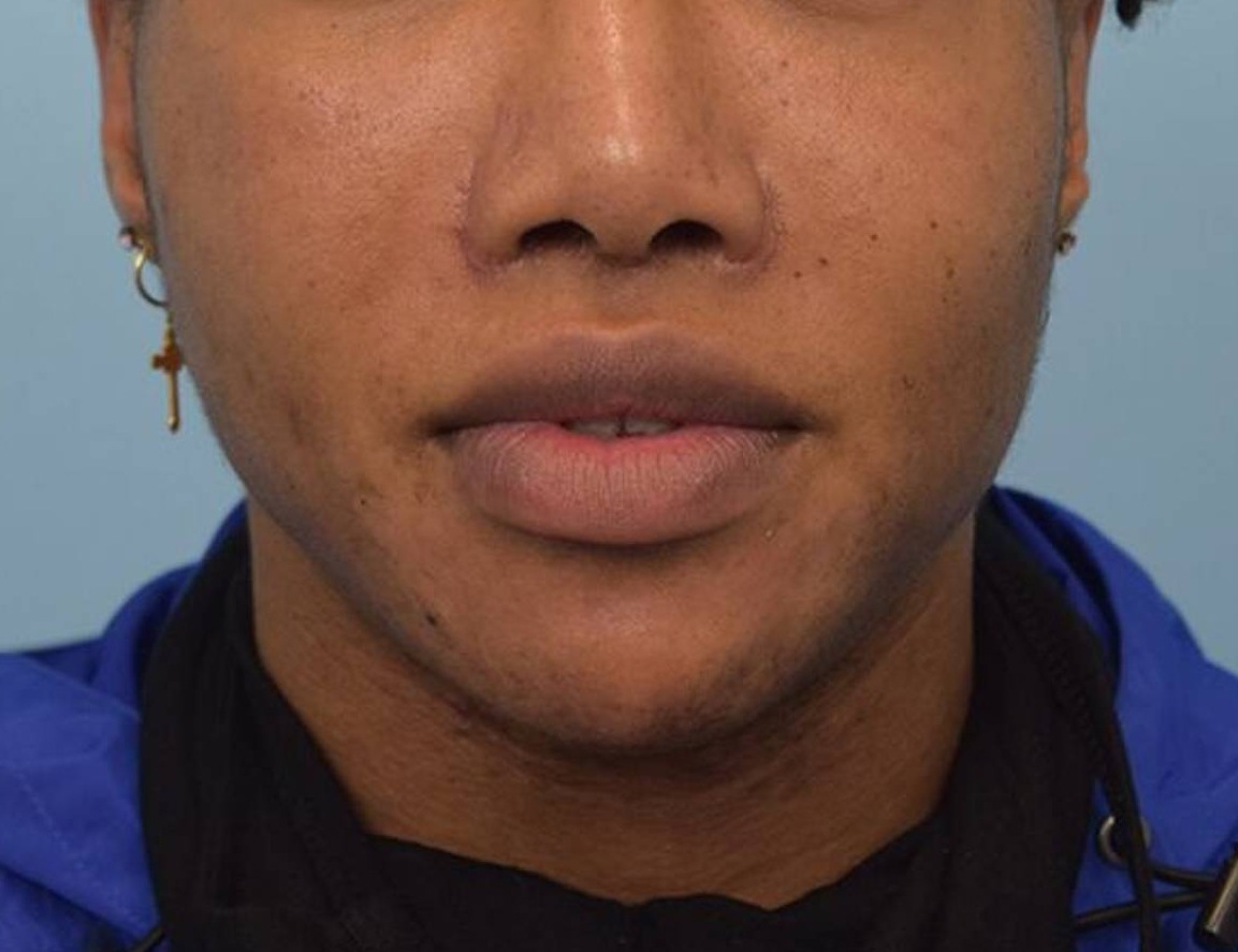 Lip Lift Before & After Image