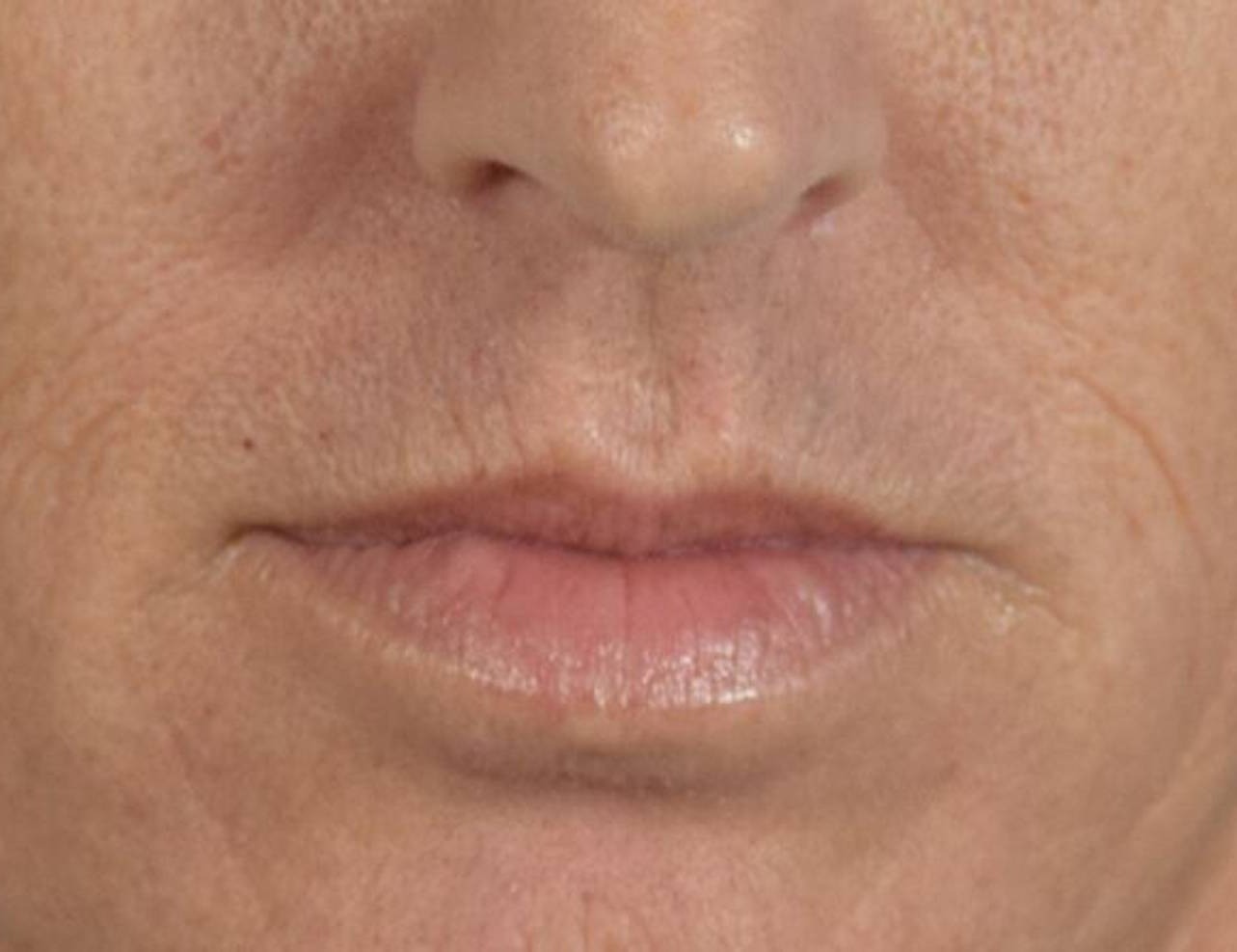 Lip Lift Before & After Image