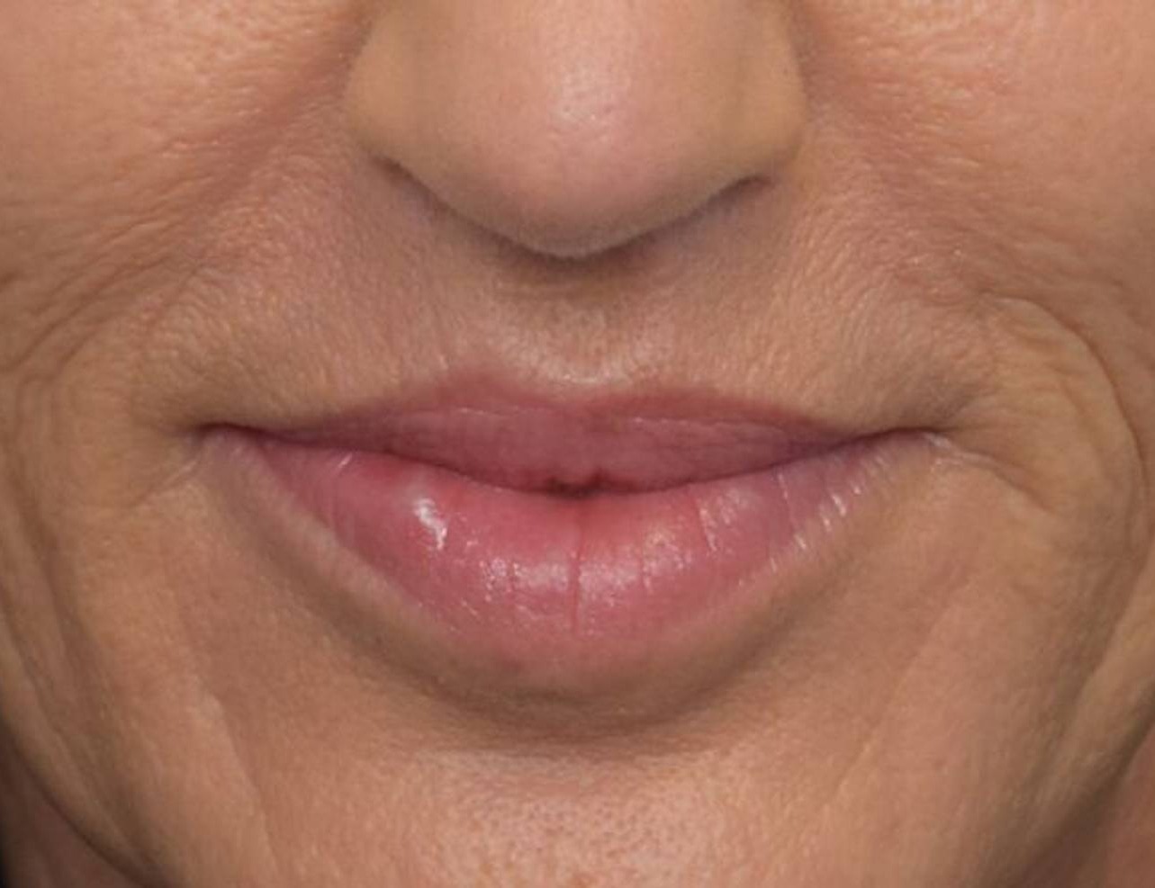 Lip Lift Before & After Image