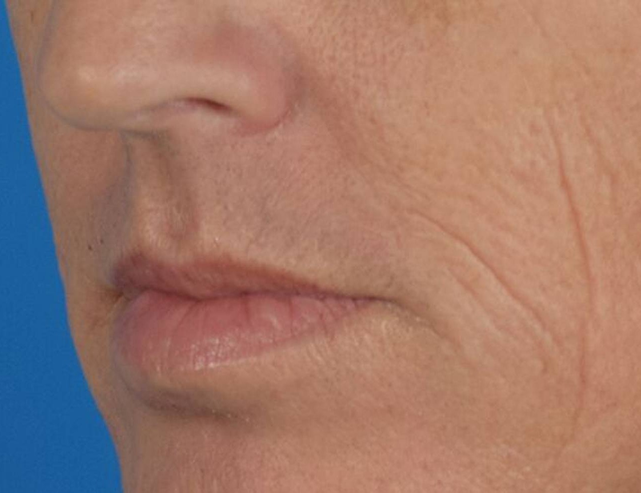 Lip Lift Before & After Image