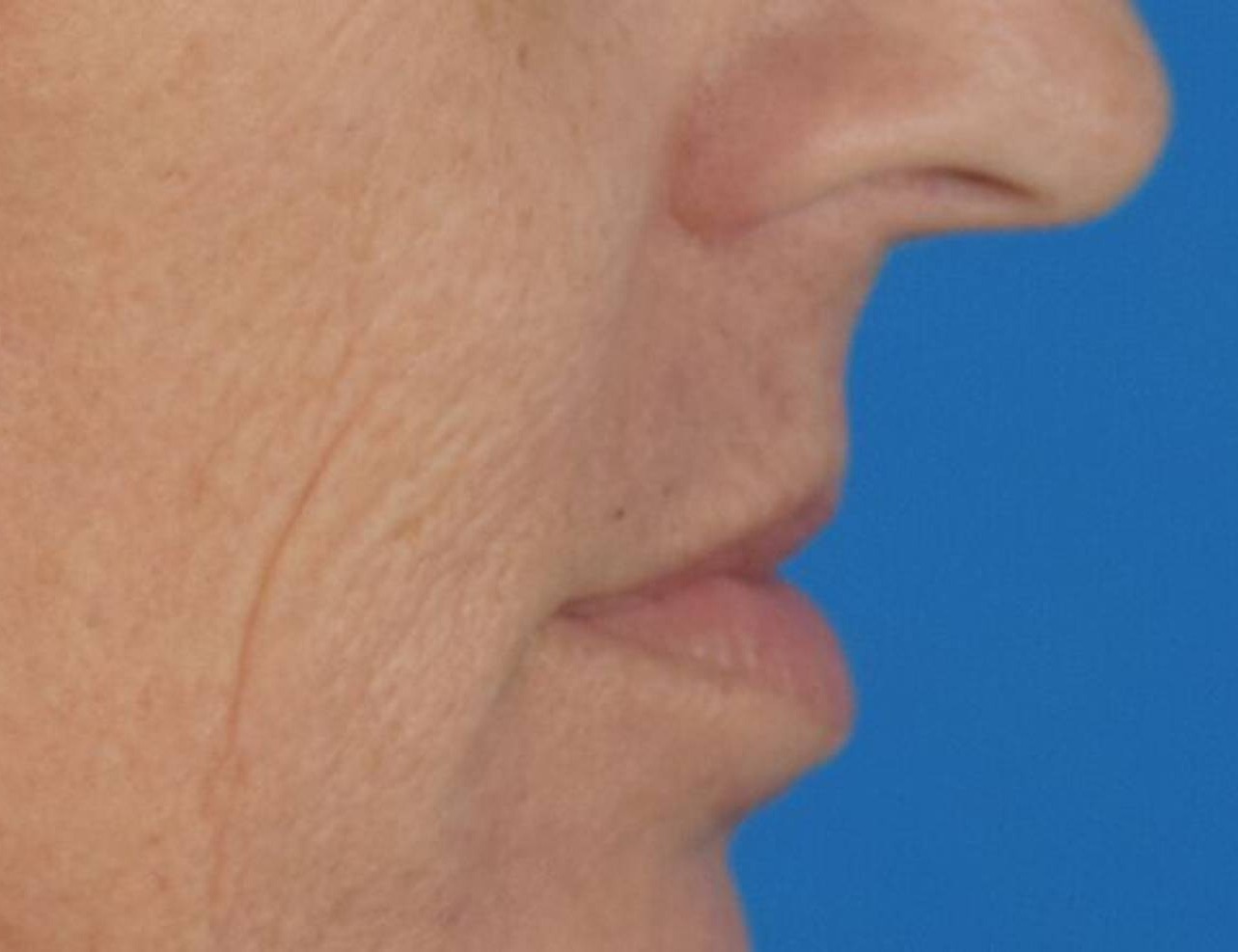 Lip Lift Before & After Image