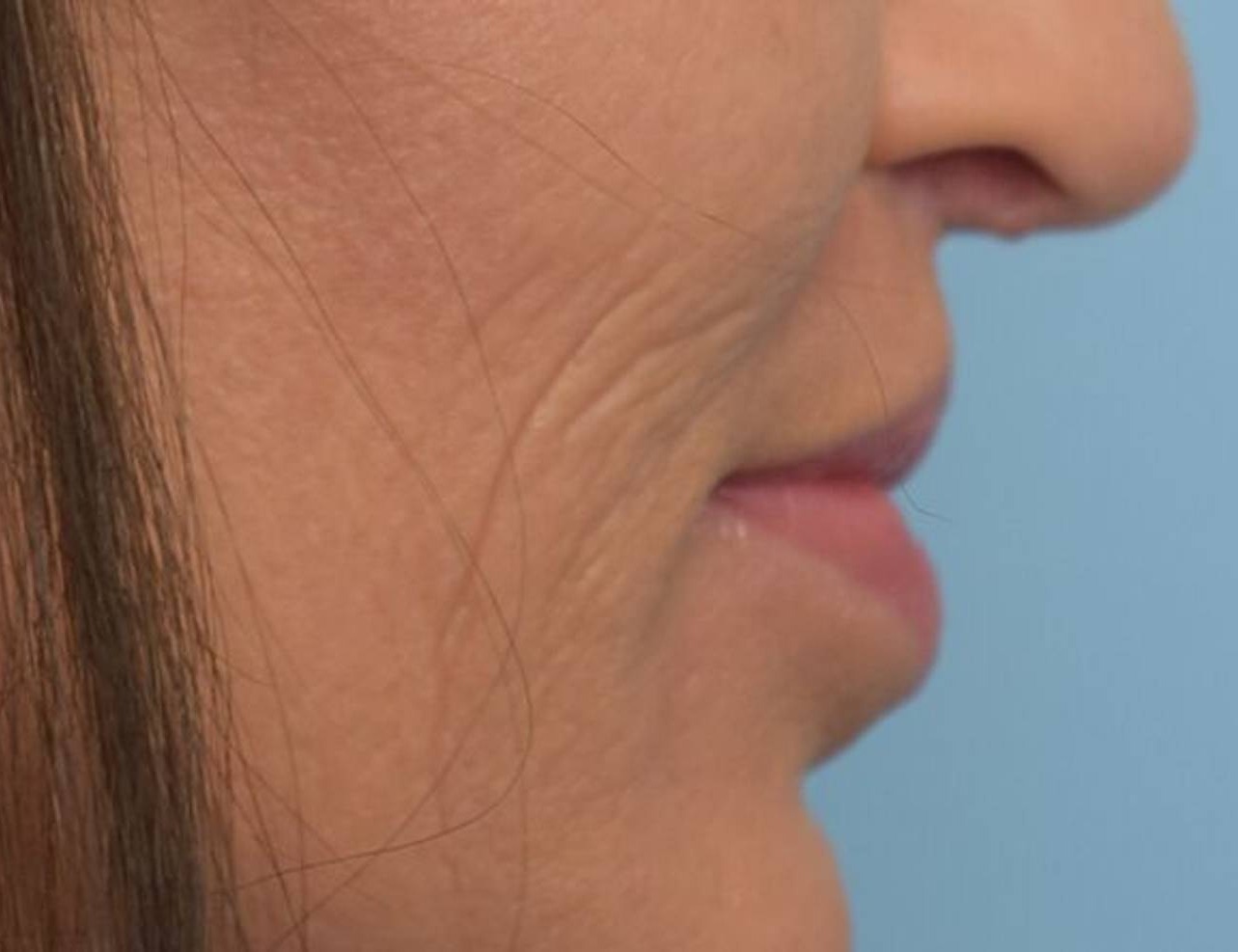 Lip Lift Before & After Image