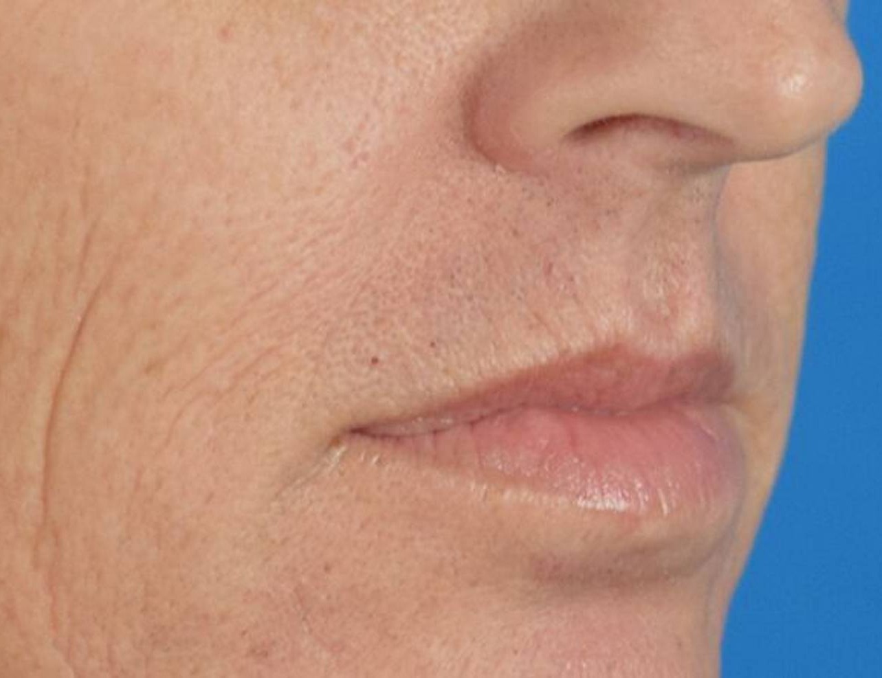 Lip Lift Before & After Image