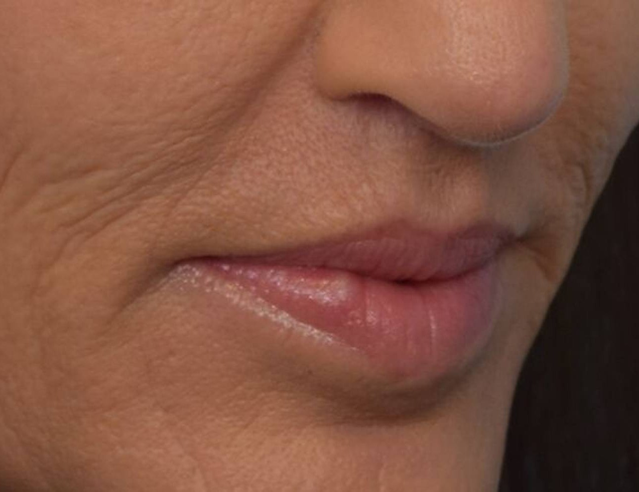 Lip Lift Before & After Image