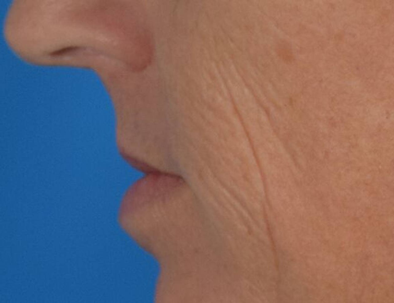 Lip Lift Before & After Image