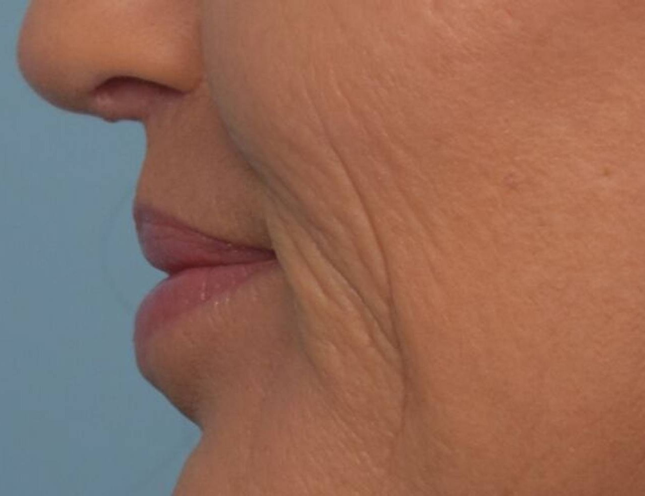 Lip Lift Before & After Image