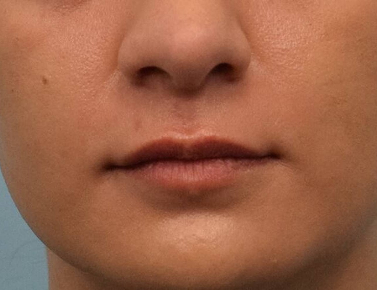 Lip Lift Before & After Image