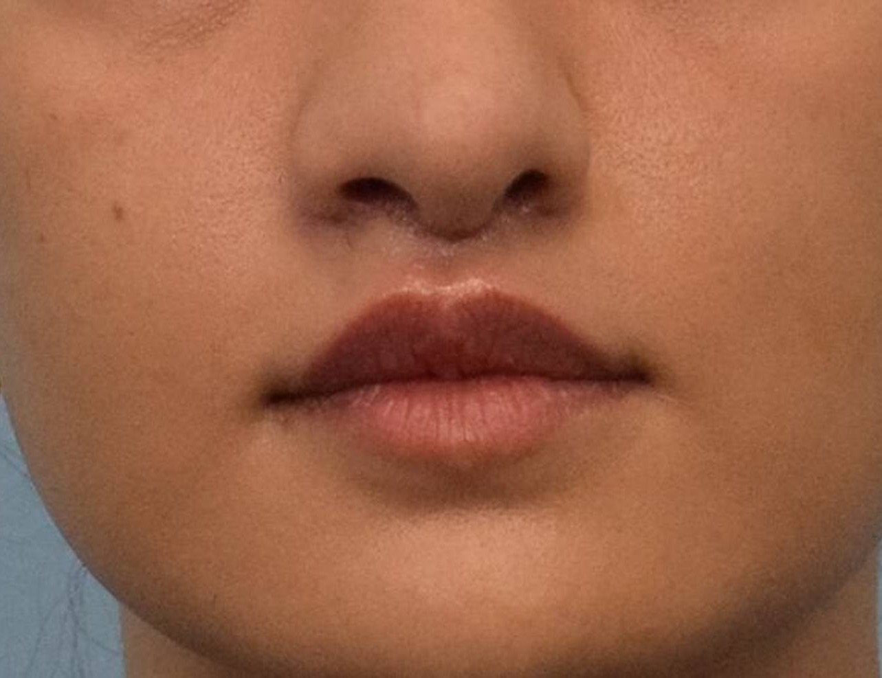 Lip Lift Before & After Image