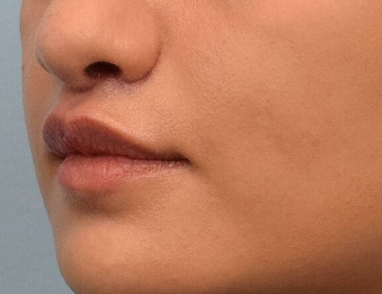 Lip Lift Before & After Image