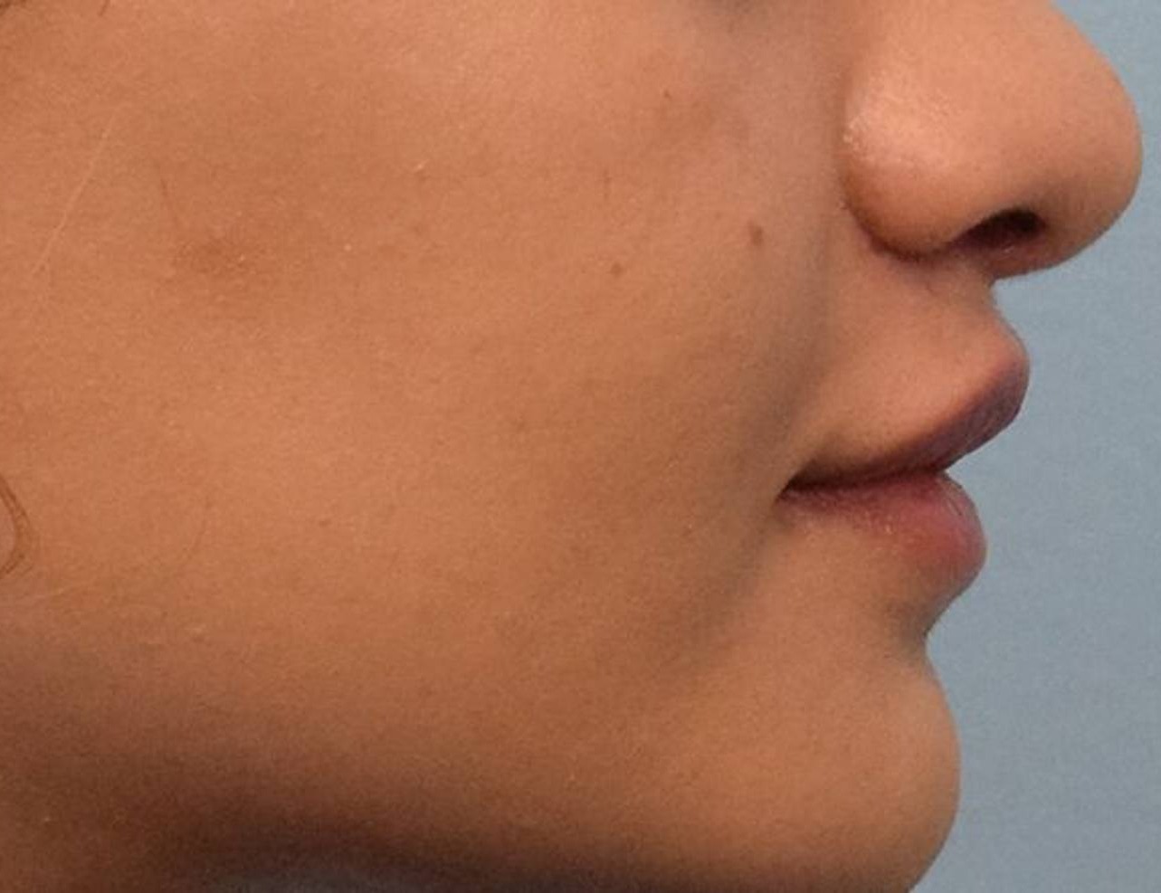 Lip Lift Before & After Image