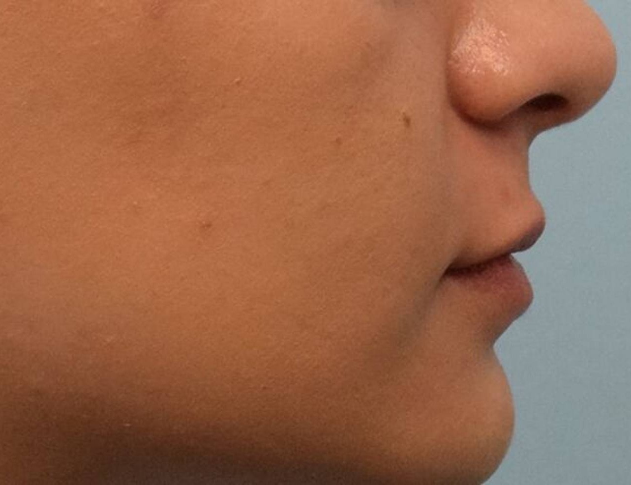 Lip Lift Before & After Image