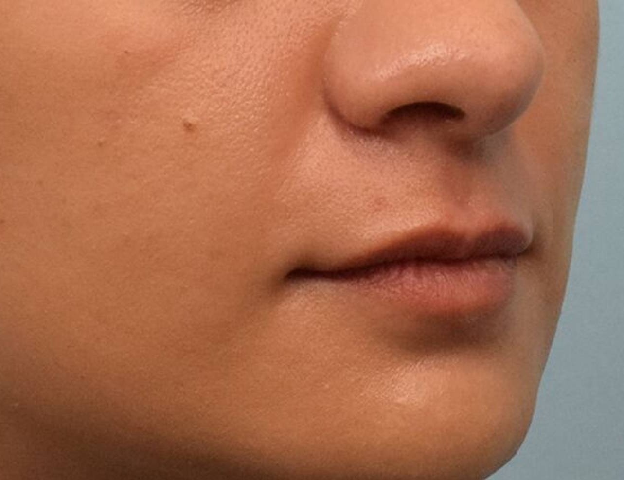 Lip Lift Before & After Image