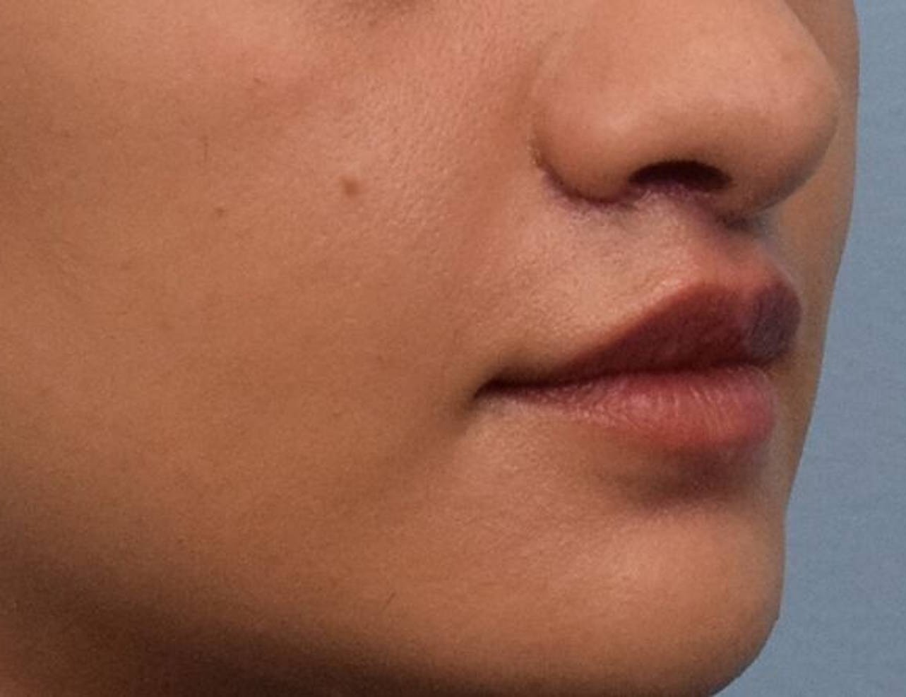 Lip Lift Before & After Image