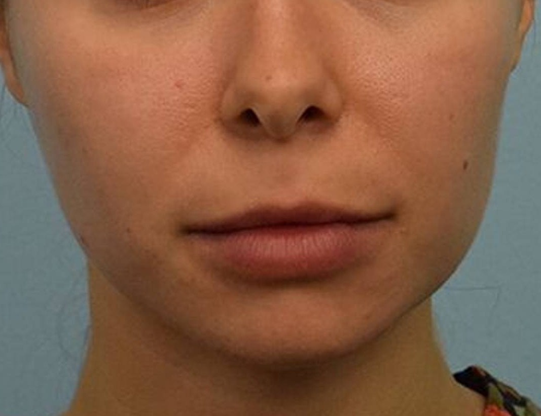 Lip Lift Before & After Image