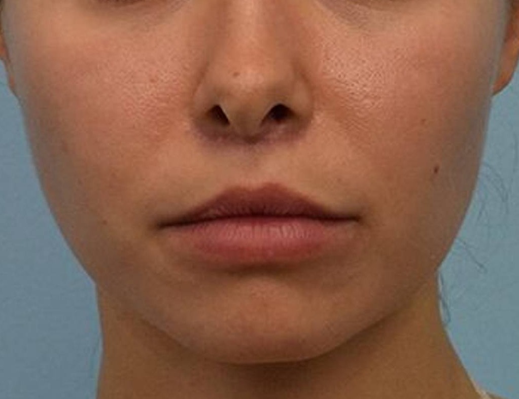 Lip Lift Before & After Image