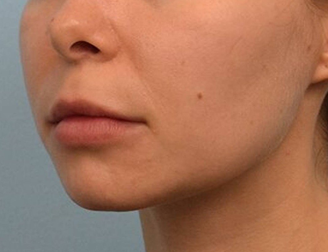 Lip Lift Before & After Image