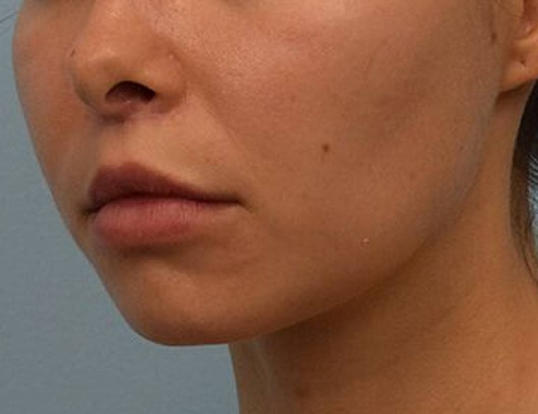 Lip Lift Before & After Image