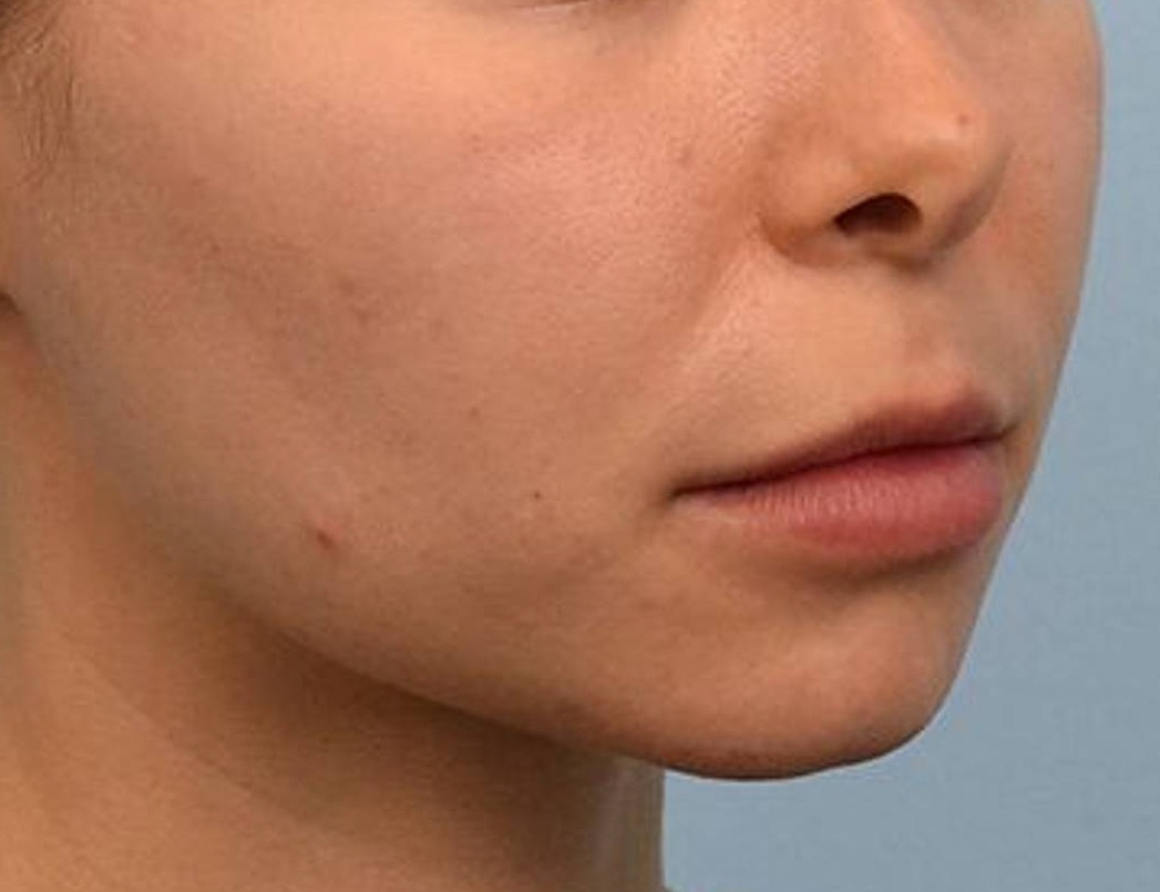 Lip Lift Before & After Image