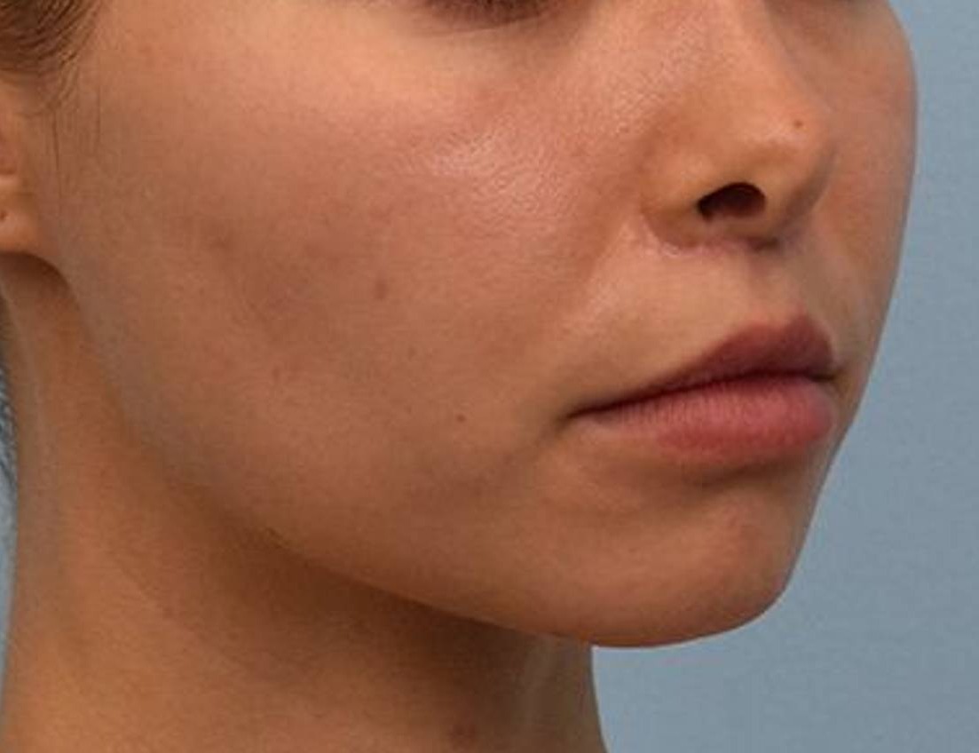 Lip Lift Before & After Image