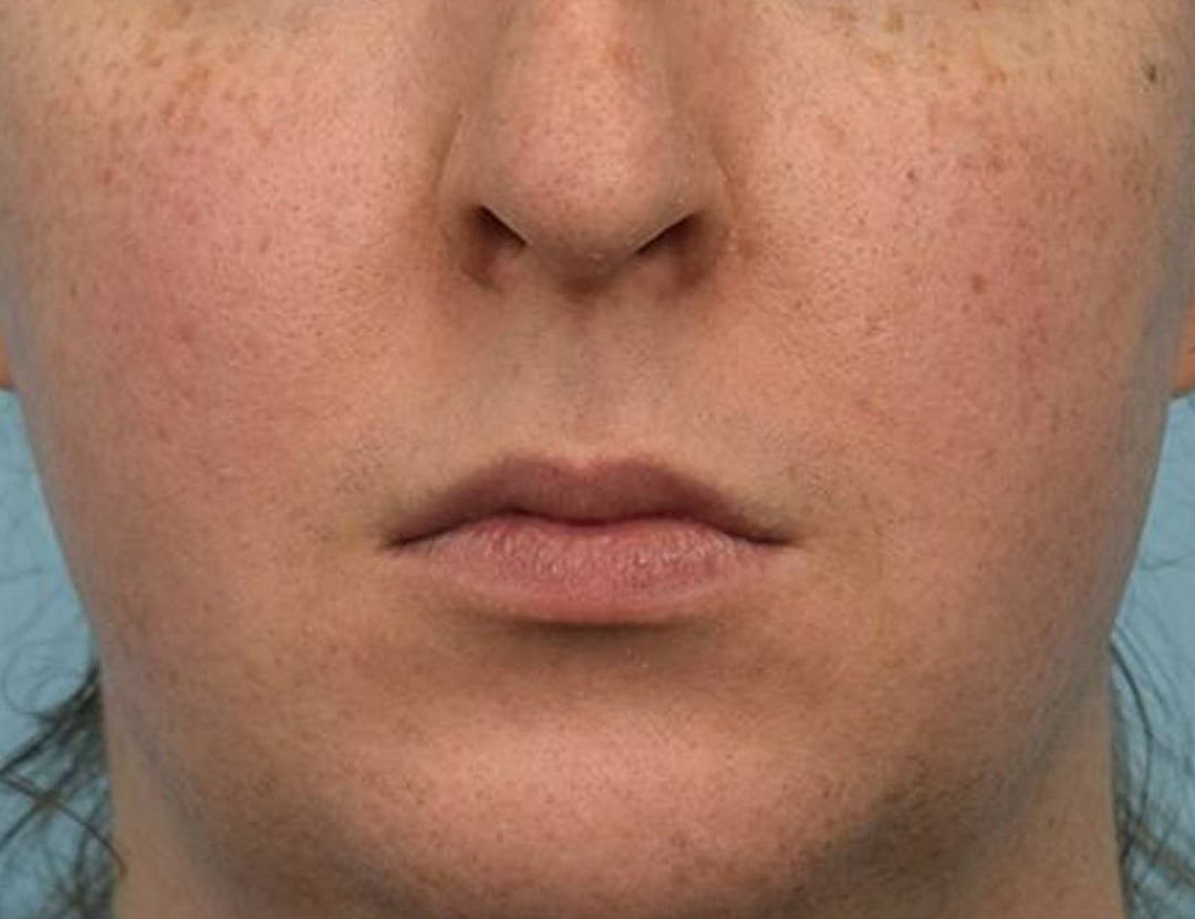 Lip Lift Before & After Image