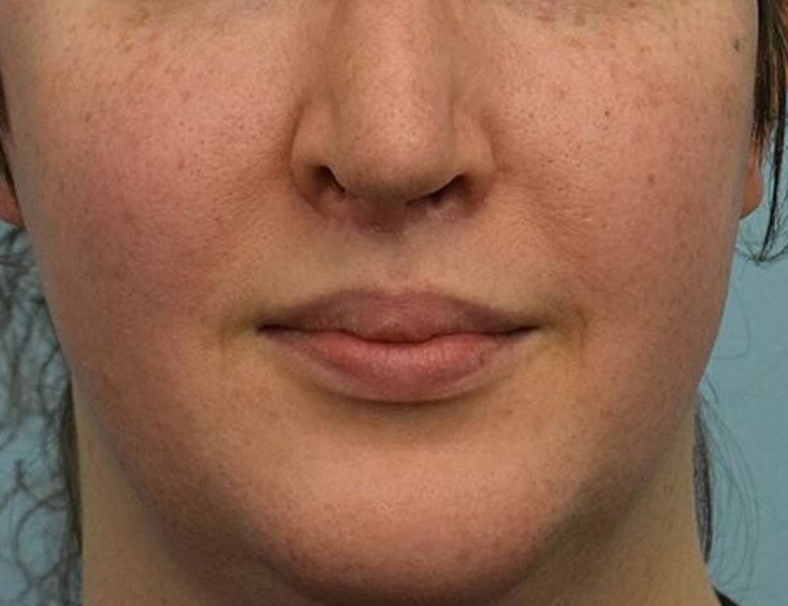 Lip Lift Before & After Image