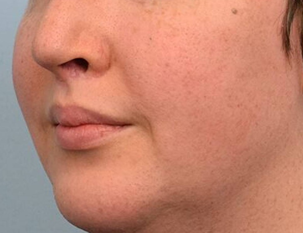 Lip Lift Before & After Image