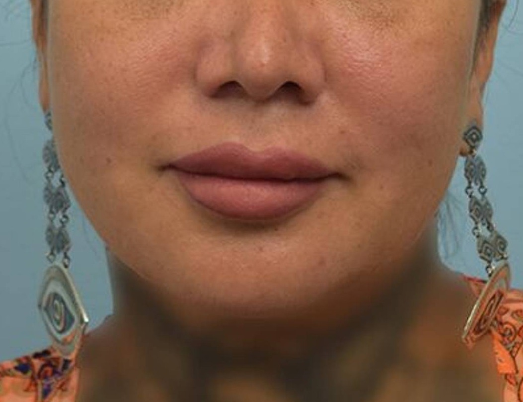 Lip Lift Before & After Image