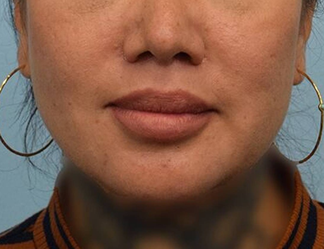 Lip Lift Before & After Image