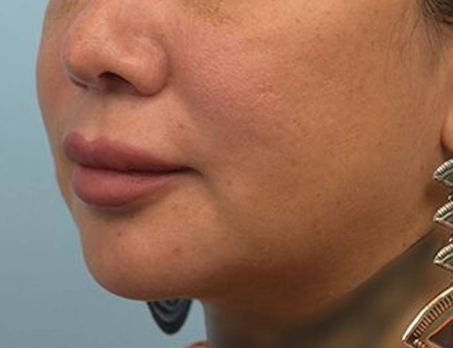 Lip Lift Before & After Image