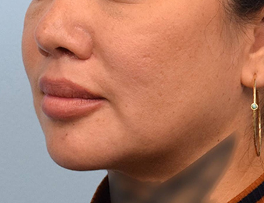 Lip Lift Before & After Image