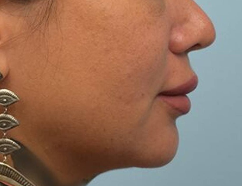 Lip Lift Before & After Image