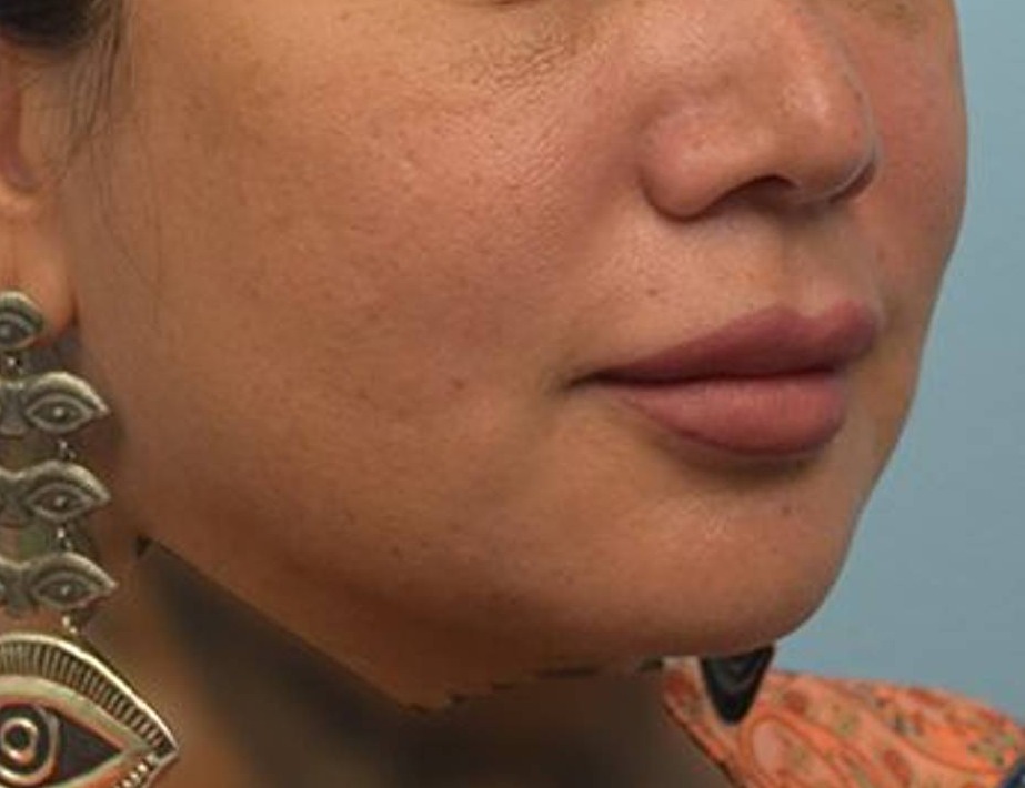 Lip Lift Before & After Image