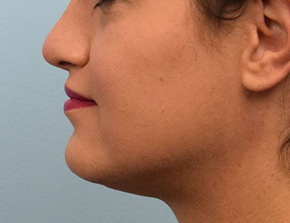 Lip Lift Before & After Image