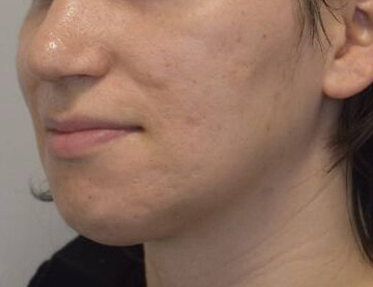 Lip Lift Before & After Image