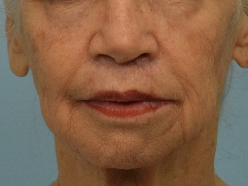 Lip Lift Before & After Image