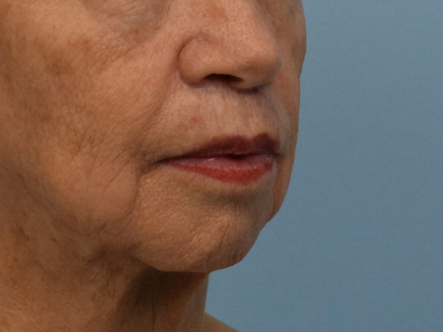 Lip Lift Before & After Image