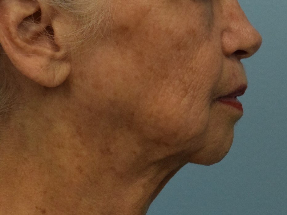 Lip Lift Before & After Image