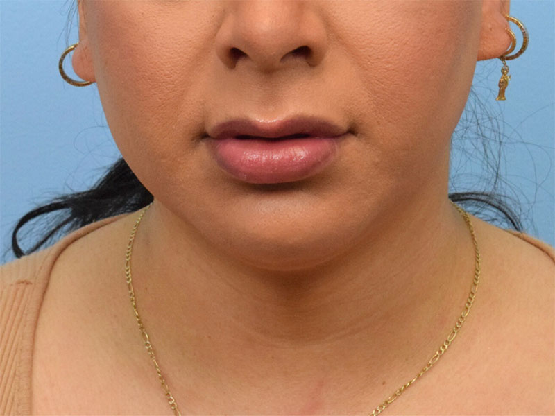 Lip Lift Before & After Image