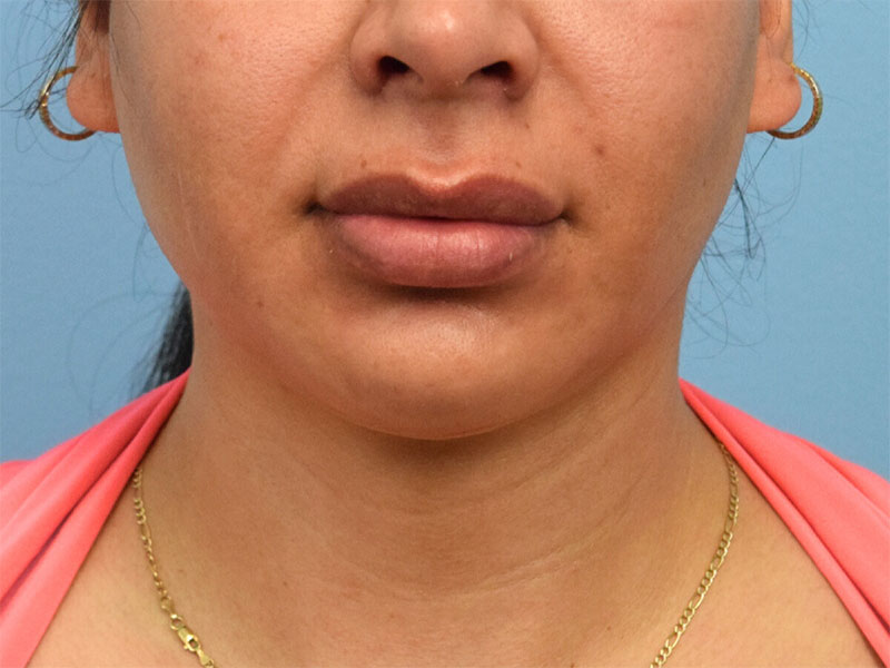 Lip Lift Before & After Image