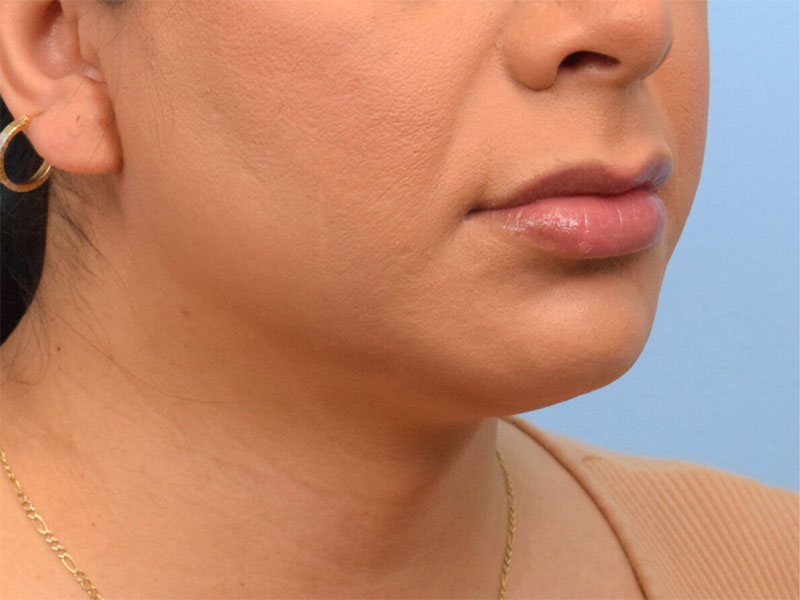 Lip Lift Before & After Image