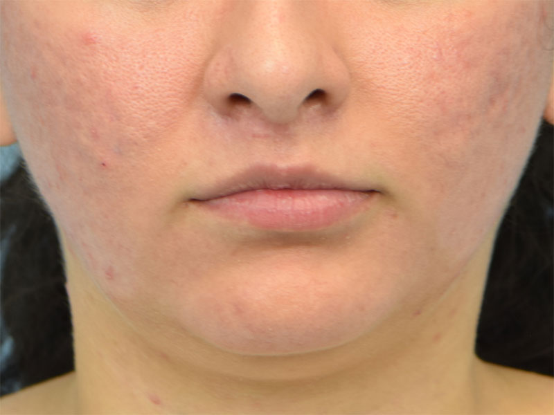 Lip Lift Before & After Image