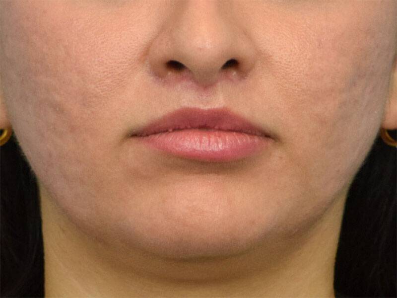 Lip Lift Before & After Image