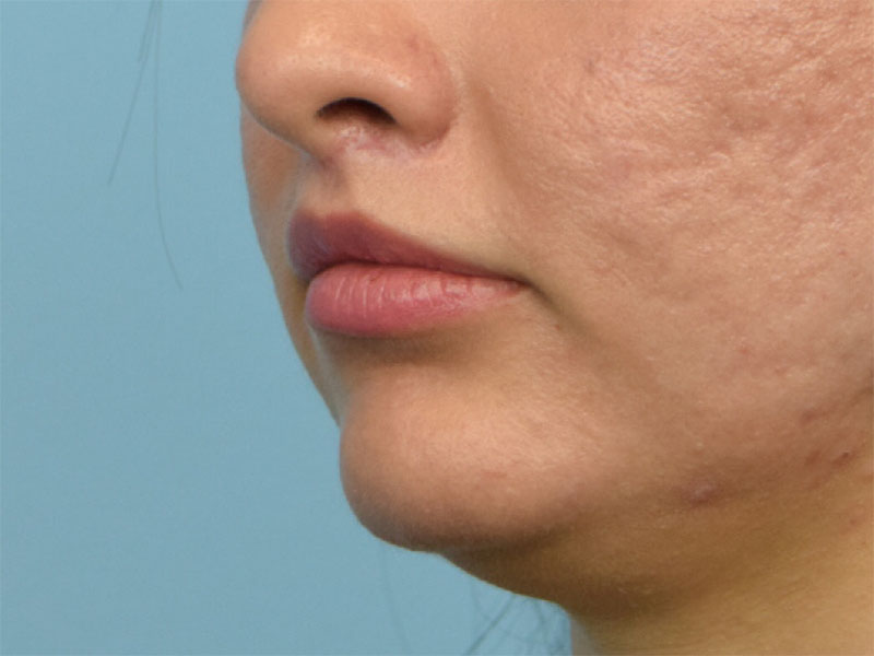 Lip Lift Before & After Image