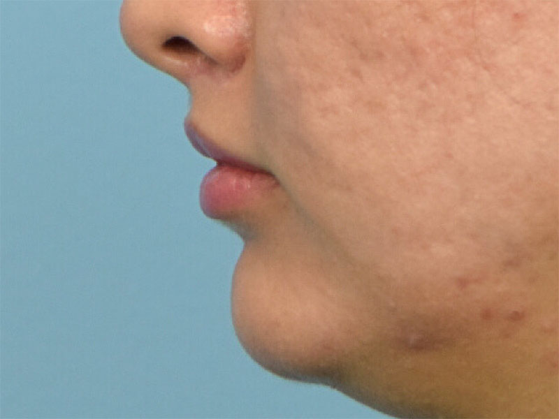 Lip Lift Before & After Image